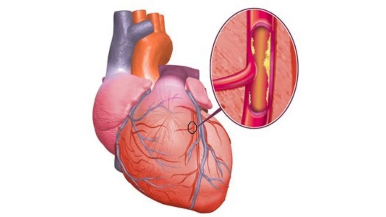 probleme cardiace din cauza tensiunii arteriale crescute